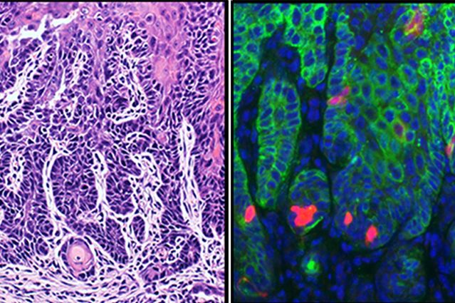 Targeting cancer stem cells improves treatment effectiveness and